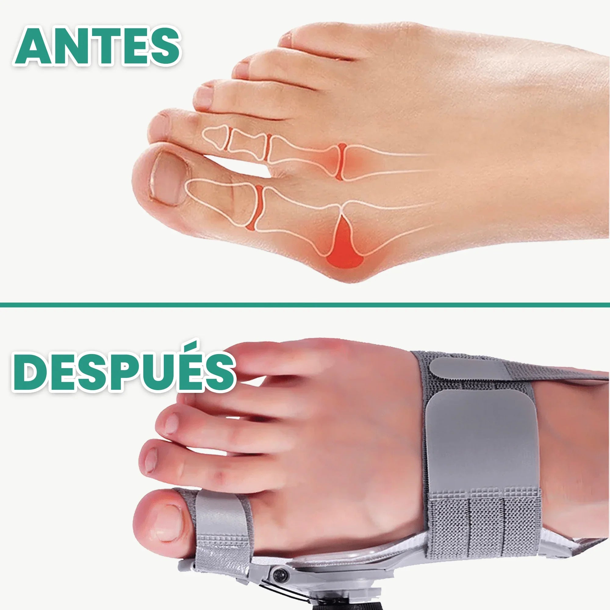 🦶 MedCorrect™ | Correctores Ortopédicos Avanzado de Juanetes + Ebook Digital 🎁